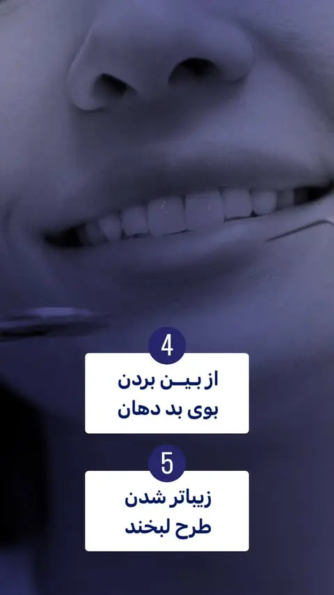 5 مورد از مهم ترین فواید جرم گیری دندان - مطب دندانپزشکی رها کرج