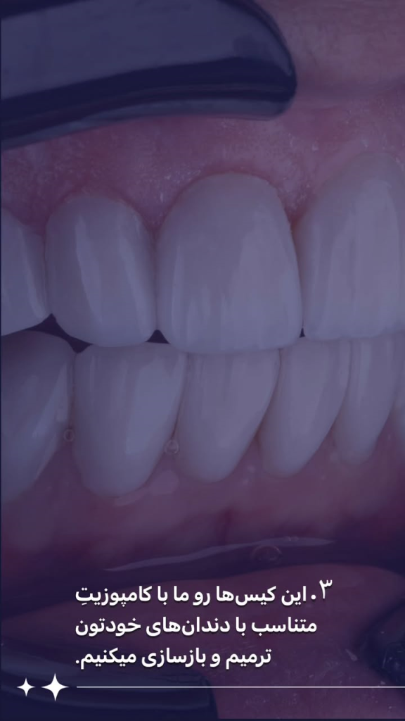 دندان پزشکی رها، کامپوزیت مناسب چه کسانی هست؟