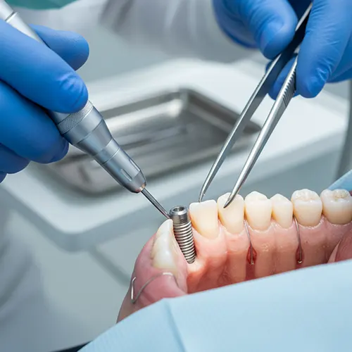 ایمپلنت دندان در داندانپزشکی رها در کرج