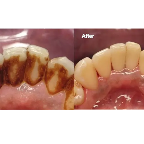 جرم‌گیری دندان دندانپزشکی رها