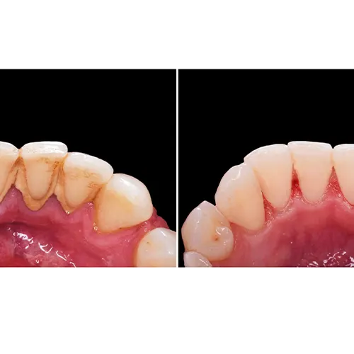 فواید جرم گیری دندان