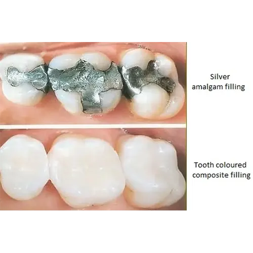 پرکردن دندان و عصب‌کشی دندان