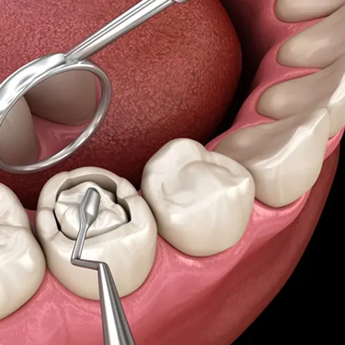 پرکردن دندان و عصب‌کشی دندان