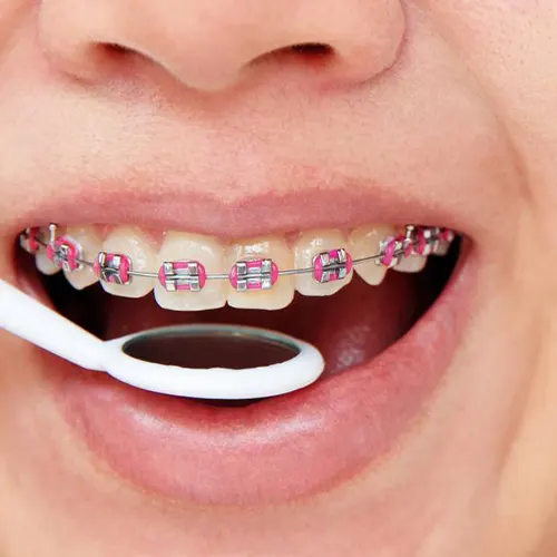 چه زمانی به ارتودنسی نیاز داریم دندانپزشکی رها در کرج