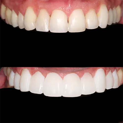 کامپوزیت دندان چیست دندانپزشکی رها کرج