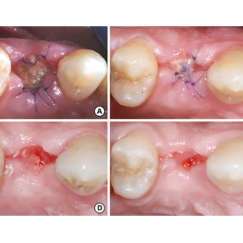 کشیدن دندان، دندانپزشکی رها