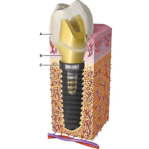 شکل II-1. اجزای ایمپلنت بازسازی‌شده.

الف) تاج ایمپلنت

ب) اباتمنت (Abutment)

ج) فیکسچر (بدنه ایمپلنت)