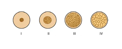 شکل II-2. انواع استخوان بر اساس مقدار استخوان قشری و چگالی مغز استخوان اسفنجی