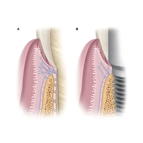 FIGURE II-5. مقایسه بافت‌ها اطراف یک دندان طبیعی سالم در مقابل یک ایمپلنت دندانی سالم. الف، دندان طبیعی دارای لیگامان‌های پریودنتال بین ریشه دندان و استخوان اطراف است. یک ناحیه بافت پیوندی بالای تاج استخوان حاوی الیاف بافت پیوندی (الیاف شارپی) است که به عاج وارد می‌شوند. اتصال اپیتلیالی تشکیل‌شده توسط اپیتلیوم شیار به تشکیل شیار لثه کمک می‌کند. ب، ایمپلنت دندانی با استخوان اسئواینتگریت شده است؛ بنابراین هیچ لیگامان پریودنتالی وجود ندارد. یک ناحیه بافت پیوندی وجود دارد، اما الیاف موازی سطح ایمپلنت قرار دارند و به آن وارد نمی‌شوند. اپیتلیوم اتصال و اپیتلیوم شیار شیار لثه را می‌پوشانند.