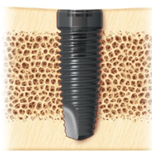 هرگاه ممکن باشد، بهینه است که هنگام قرار دادن ایمپلنت دو صفحه قشری را درگیر کنیم.