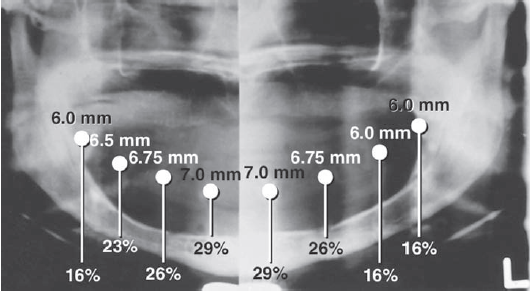 شکل III‑1 — رادیوگراف پانورامیک با گوی‌های فولادی استاندارد