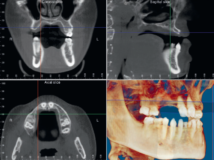 شکل III‑2 — اسکن CBCT سه‌بعدی فک بالا