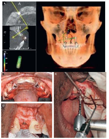 Anterior Surgical Guide