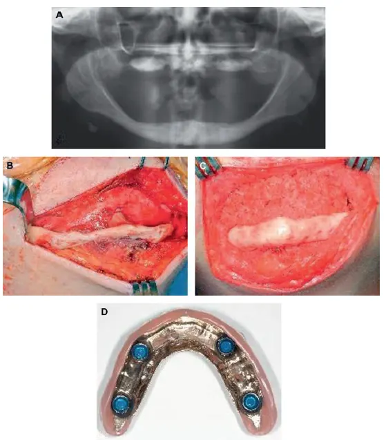 Augmentation of atrophic edentulous mandible