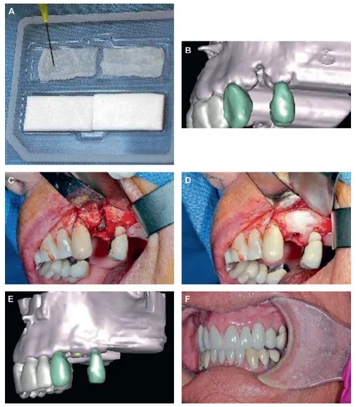 Bone Morphogenetic Protein BMP Kit and CT Images