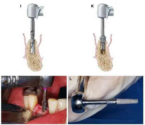 Final Drill Osteotomy Preparation