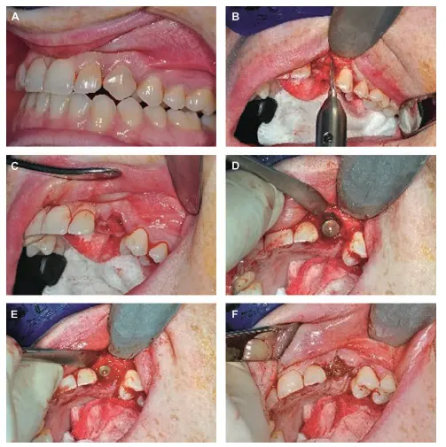 Immediate postextraction placement of implant