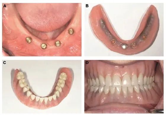 Overdenture treatment with Locator attachments