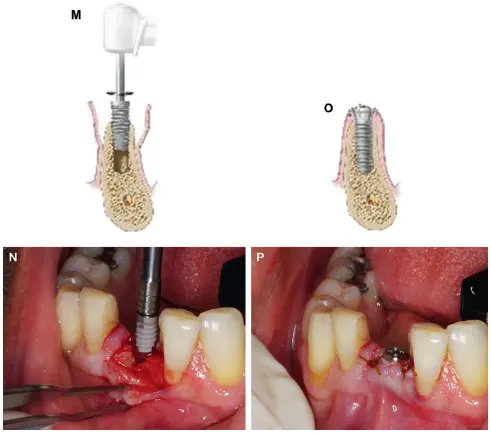 Implant Placement with Manual Driver