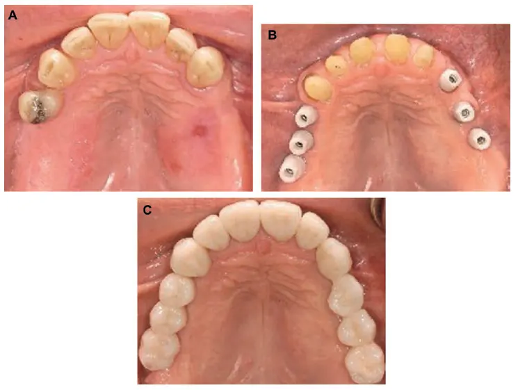 شکل VII‑11. بازسازی دوطرفه ناحیه خلفی فک بالا