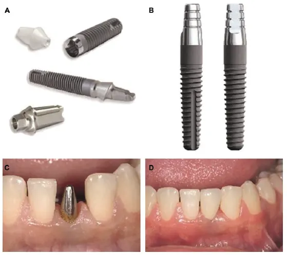 Single-stage and two-stage implants