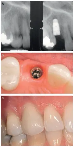 شکل VII‑8. جایگزینی دندان منفرد