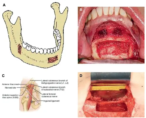 Sites of autogenous bone graft harvest