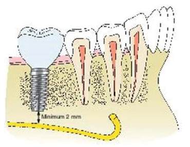 The apical end of posterior mandibular implants