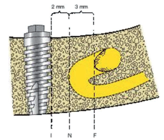 The most anterior extent of the bony mental foramen