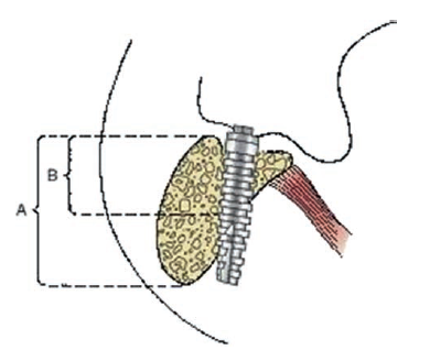 The mylohyoid muscle tends to maintain the bone