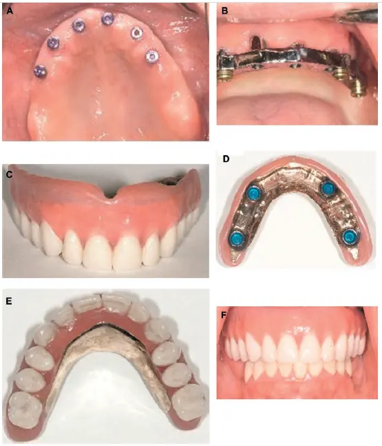 Treatment of edentulous maxilla with implant-supported overdenture