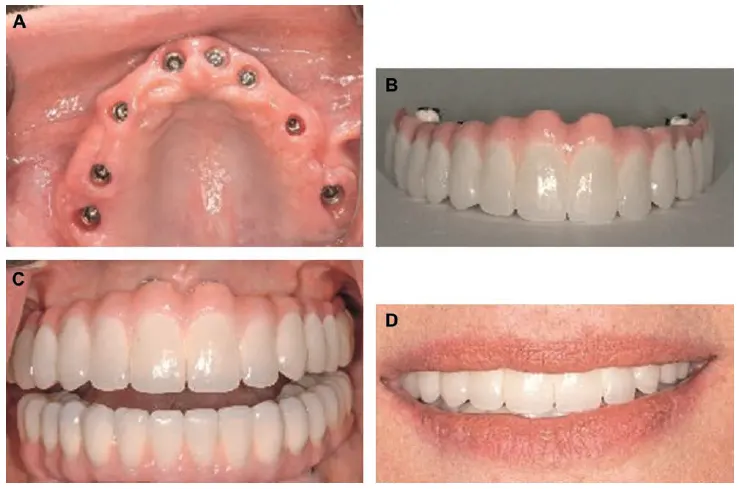 Fixed implant-supported prosthesis for edentulous maxilla