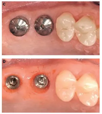 Two Healing Abutments