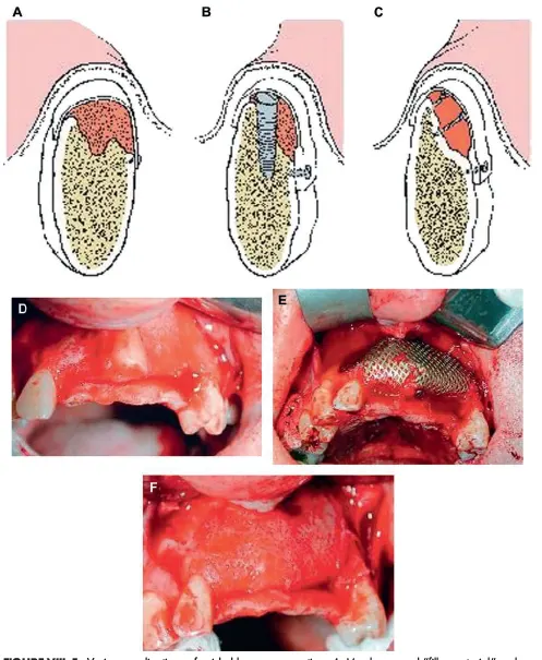 Various applications of guided bone regeneration