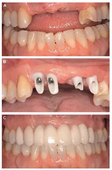 شکل VII‑10. جایگزینی پنج دندان قدامی فک بالا