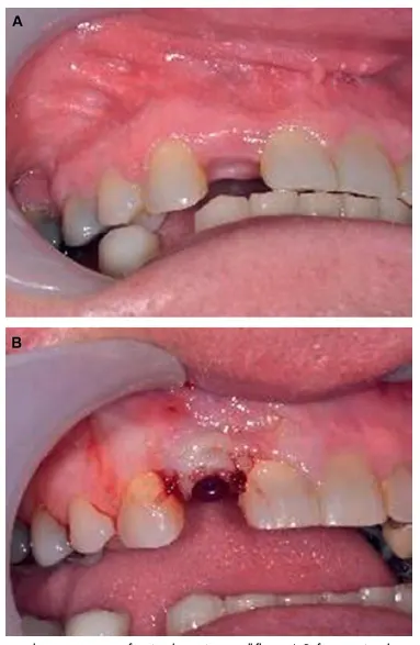 Flap Exposure Technique