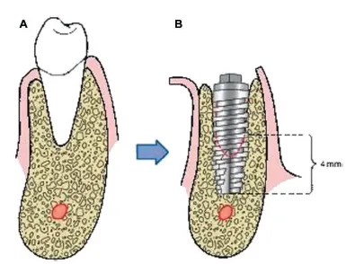 Implant placed into a fresh extraction socket