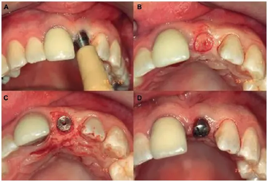 Tissue Punch Technique